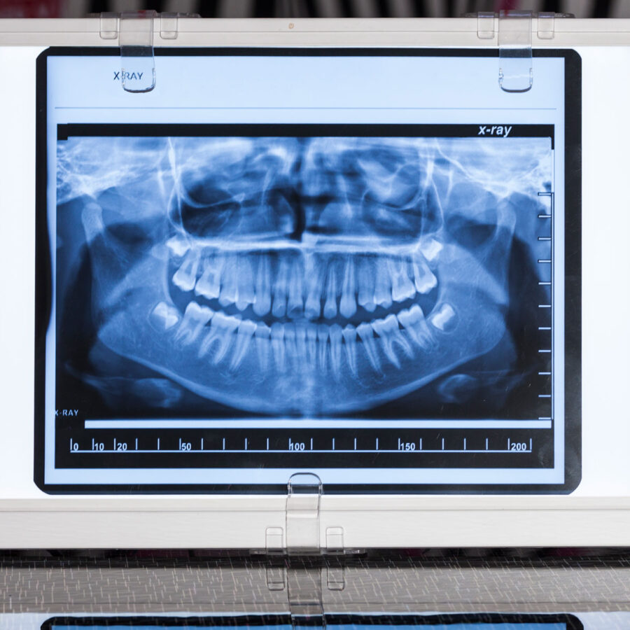X-ray picture of front teeth.