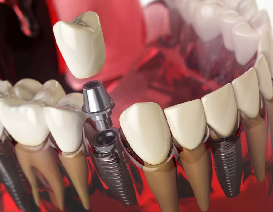 ​Types of Dental Implants