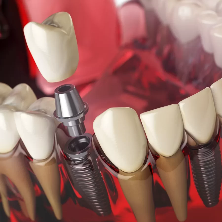 ​Types of Dental Implants