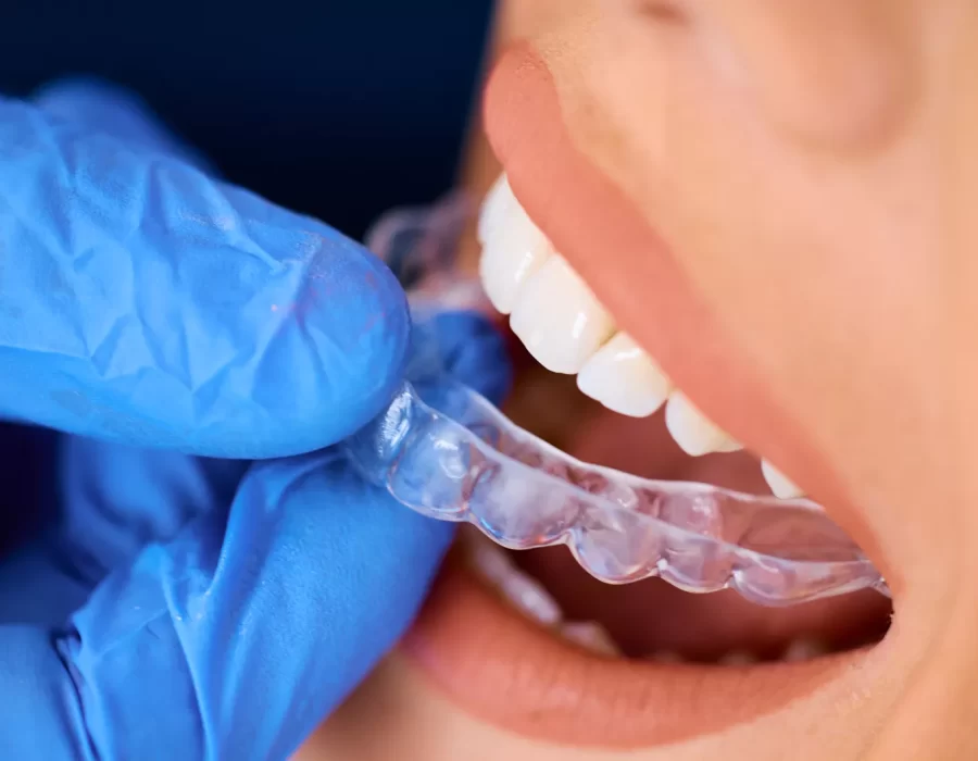 Invisalign Treatment Process