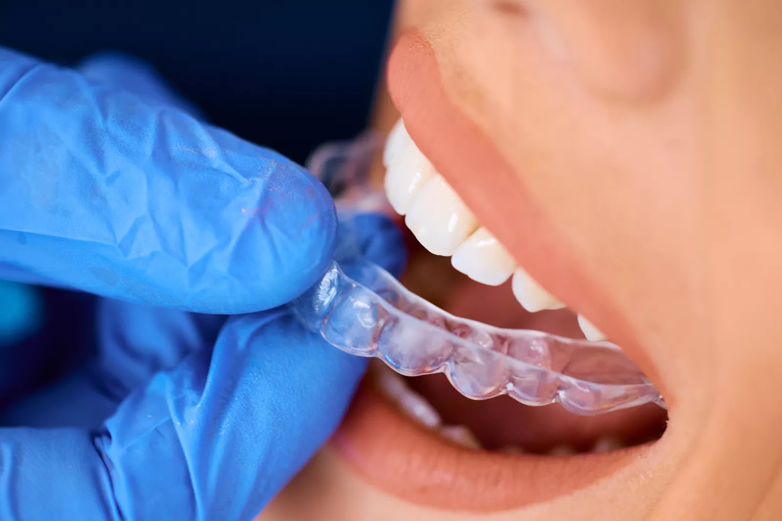 Invisalign Treatment Process