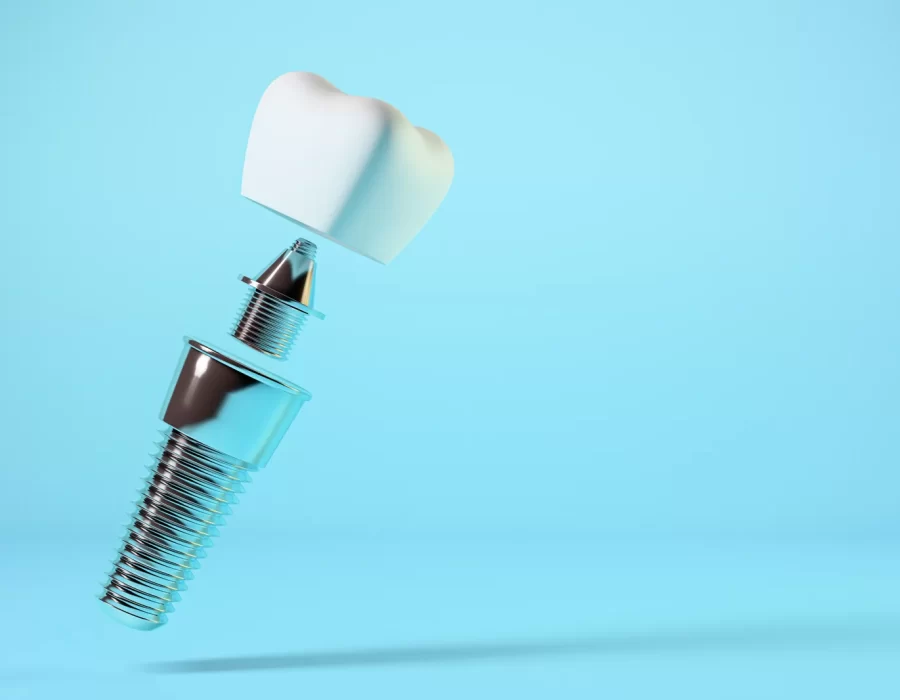 Ceramic Dental Implant Restorations