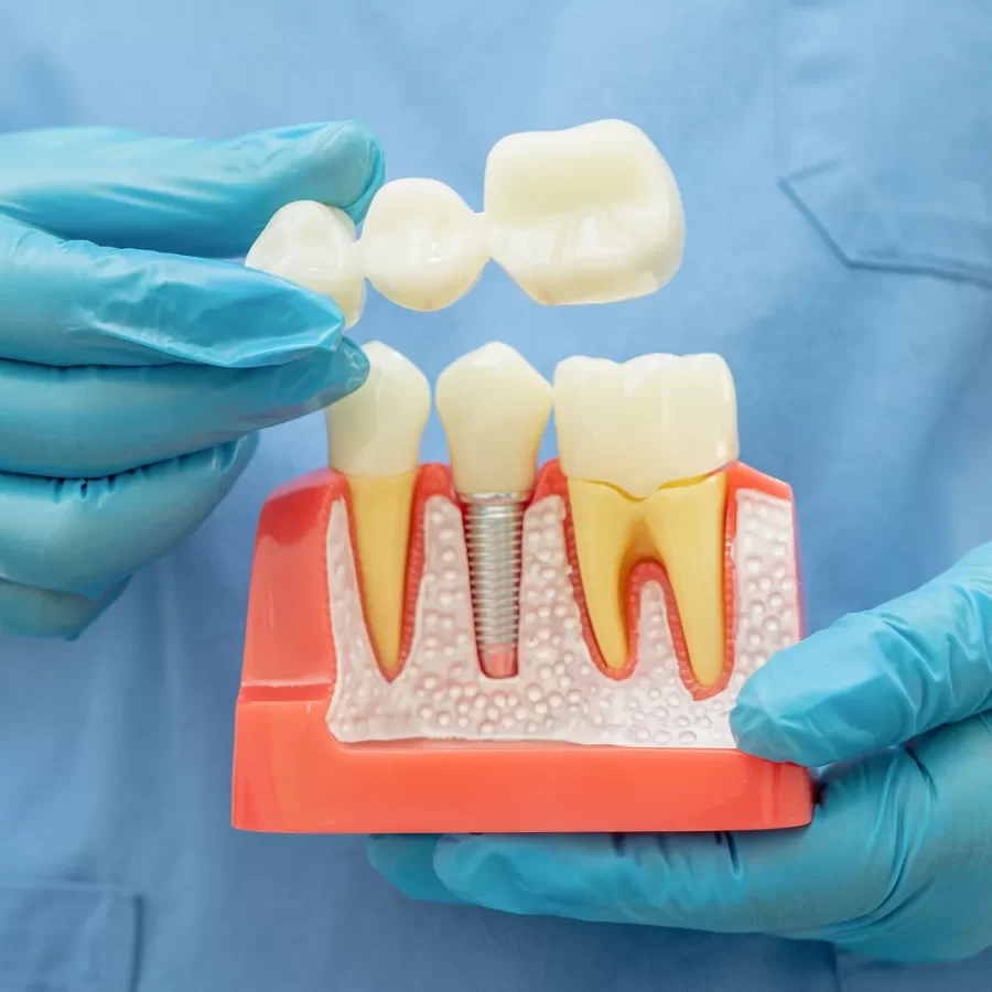 ​Dental Crowns and Bridges