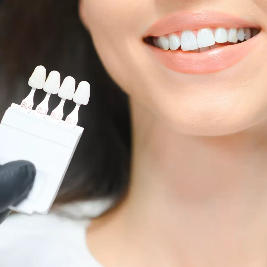 Dental Veneers