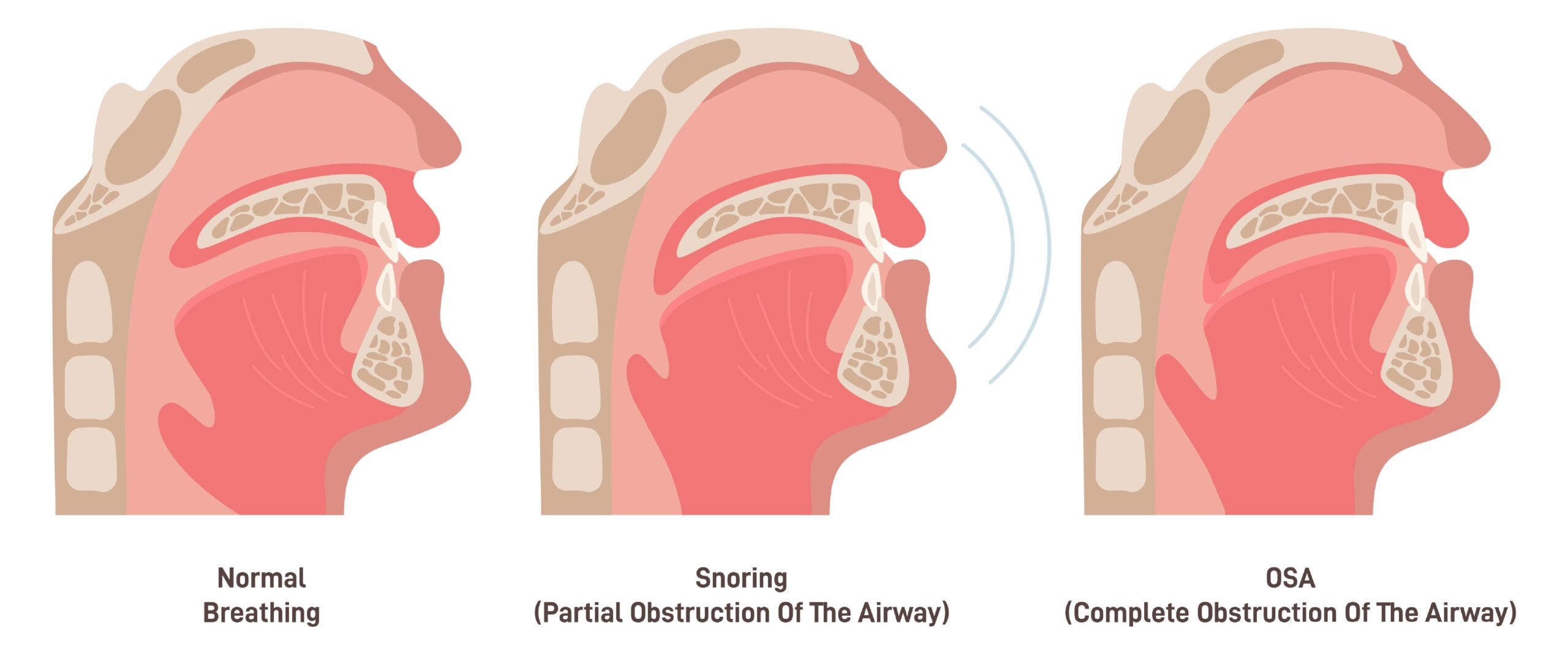 Diagram showing how obstructive sleep apnea occurs