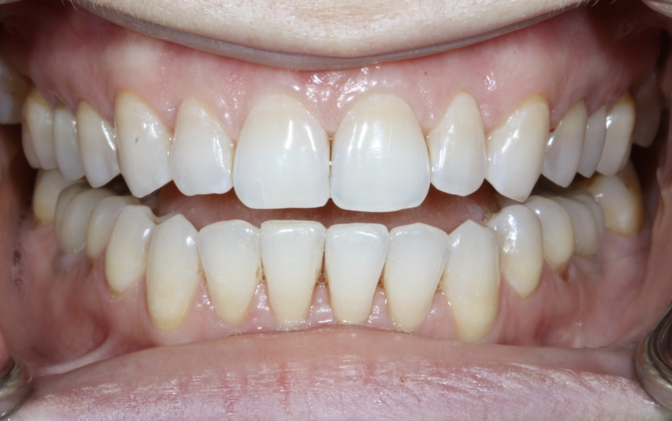 Example of a person's teeth after Invisalign