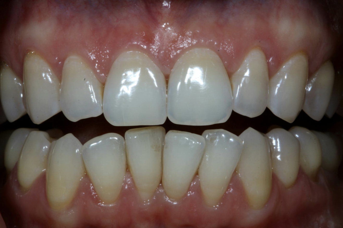 Example of a person's teeth before Invisalign
