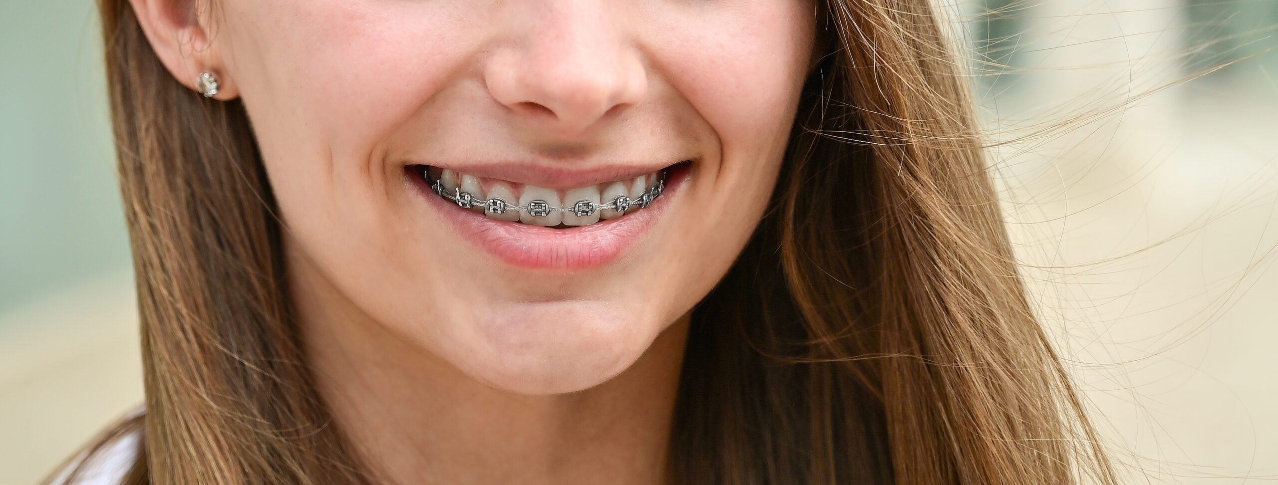 Braces vs Invisalign