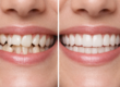 Invisalign before and after results