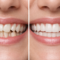 Invisalign before and after results