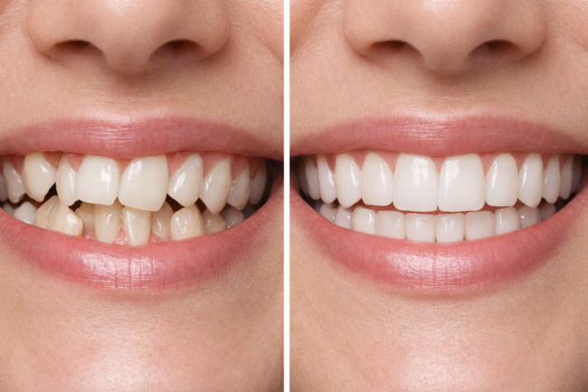 Invisalign before and after results