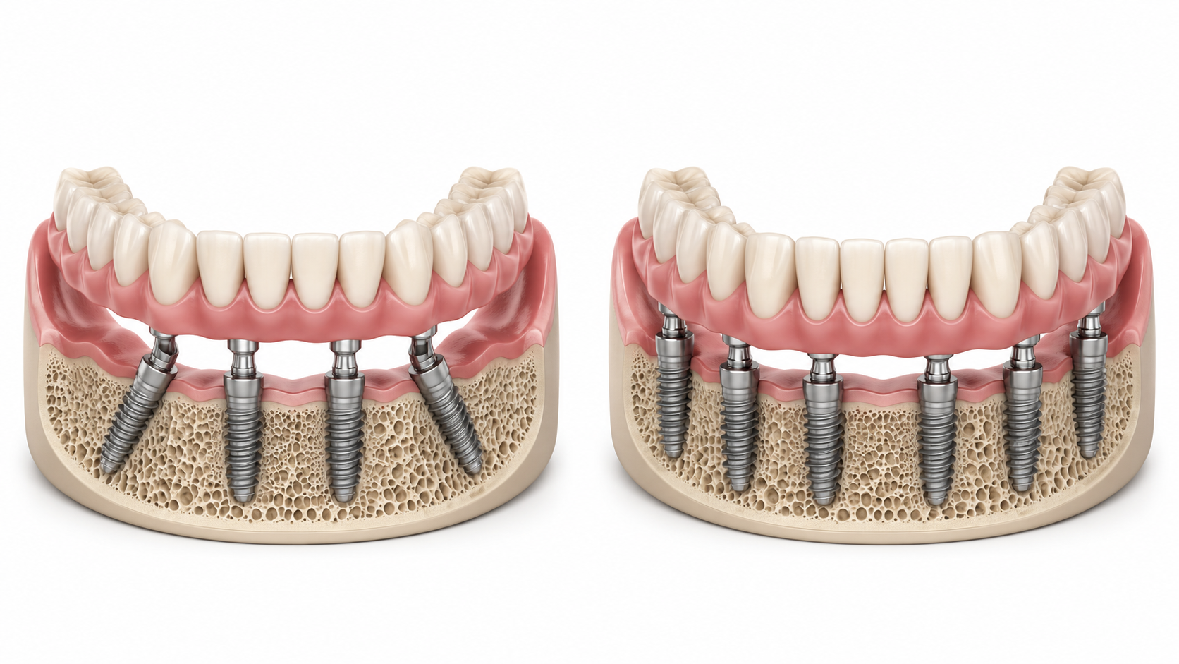 All-on-4 vs all-on-6 dental implants