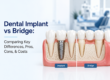 Dental implant vs dental bridge featured image