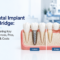 Dental implant vs dental bridge featured image