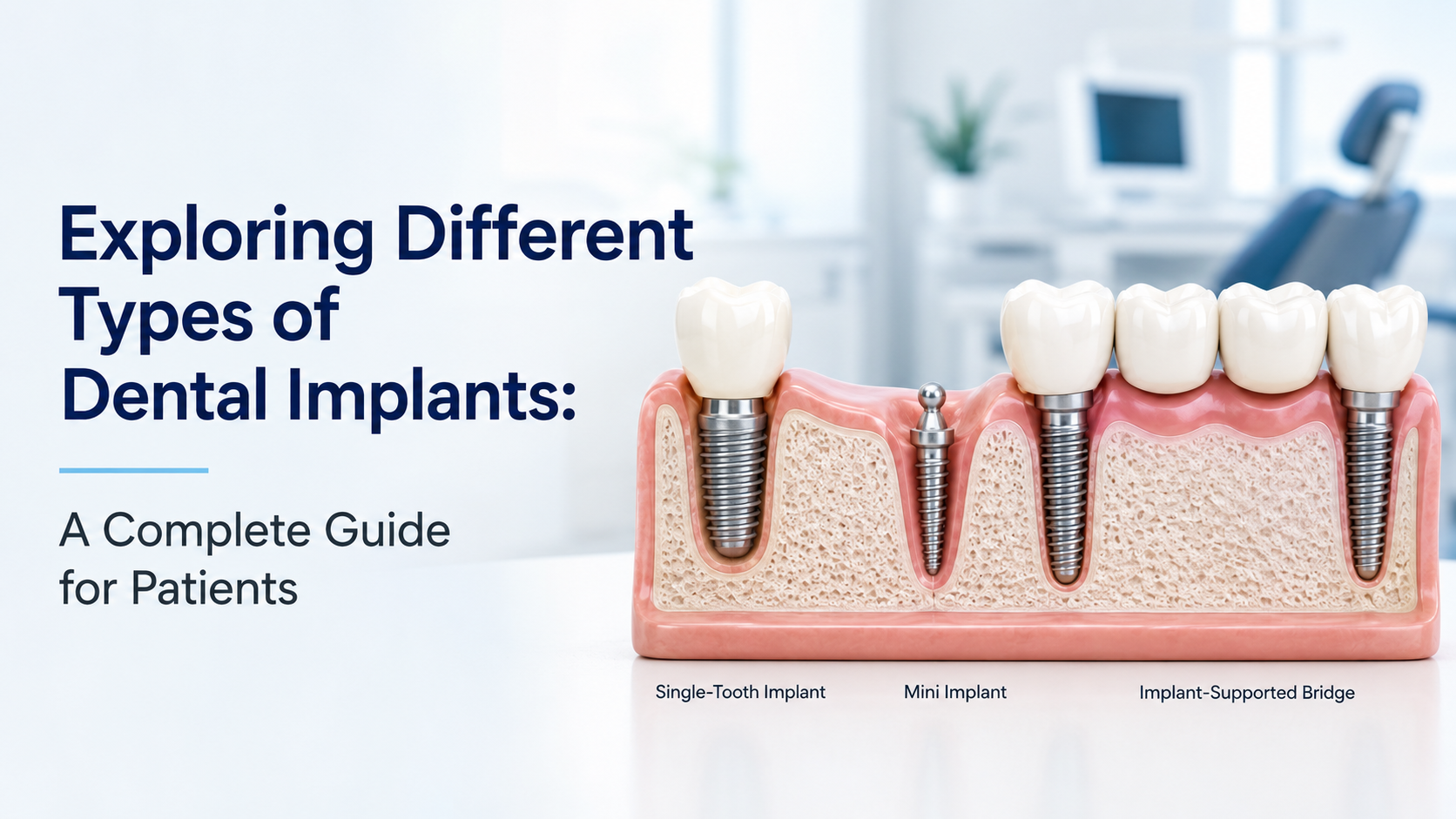 Featured image for different types of dental implants
