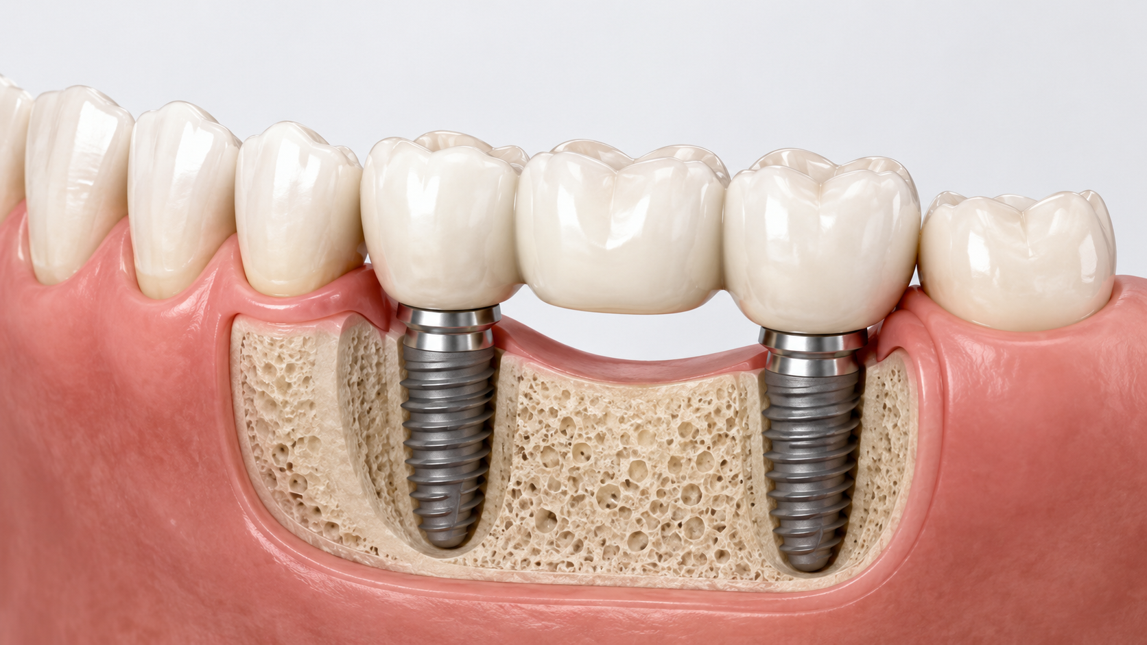 Implant supported dental implant