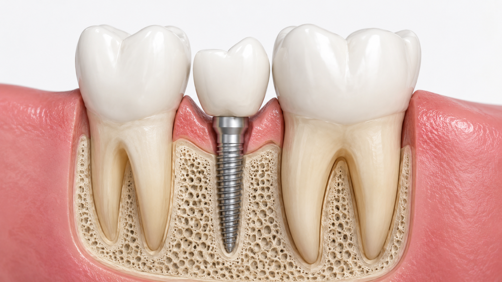 Mini dental implant