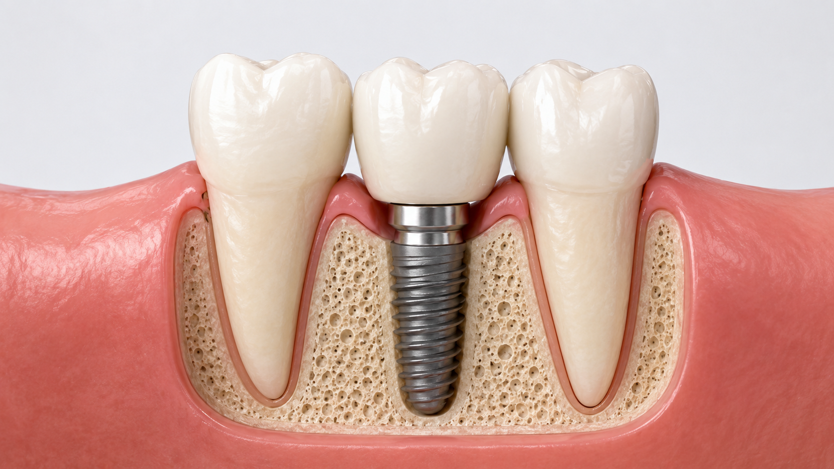 Single tooth dental implant