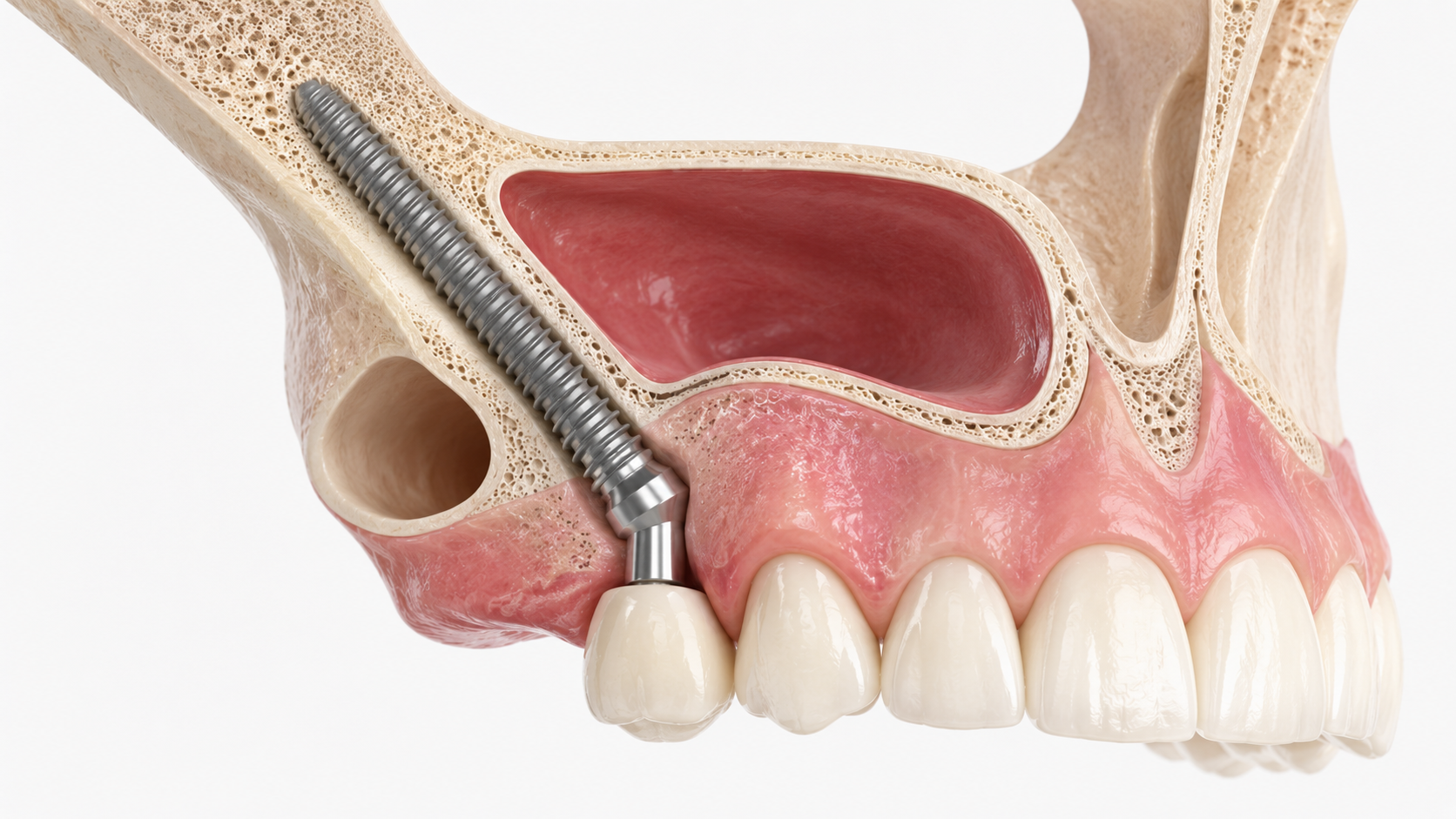 Zygomatic dental implant