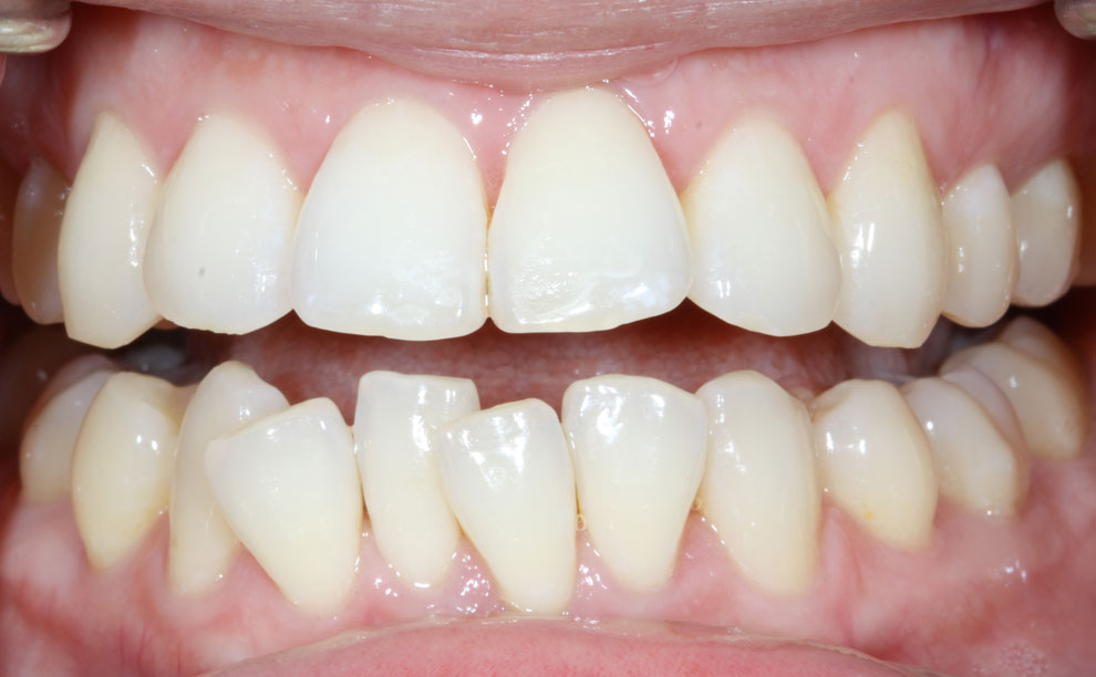 Before picture of teeth before procedure.