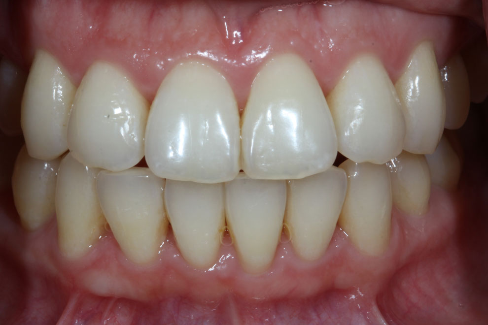 After picture of teeth when procedure is done.