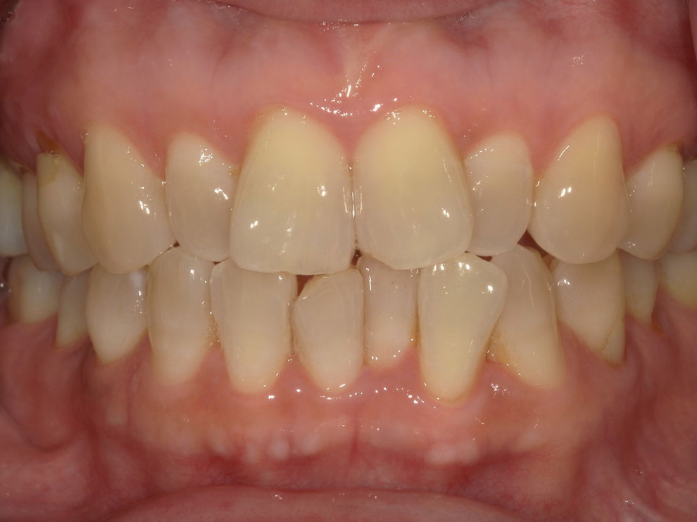 Before picture of teeth before procedure.