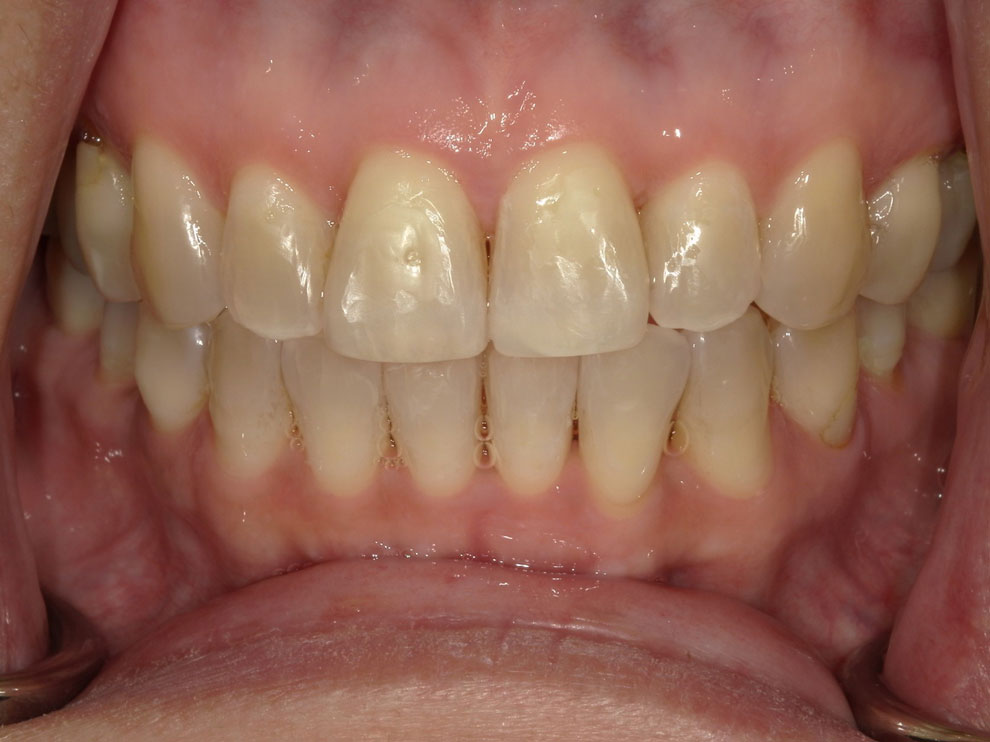 After picture of teeth when procedure is done.