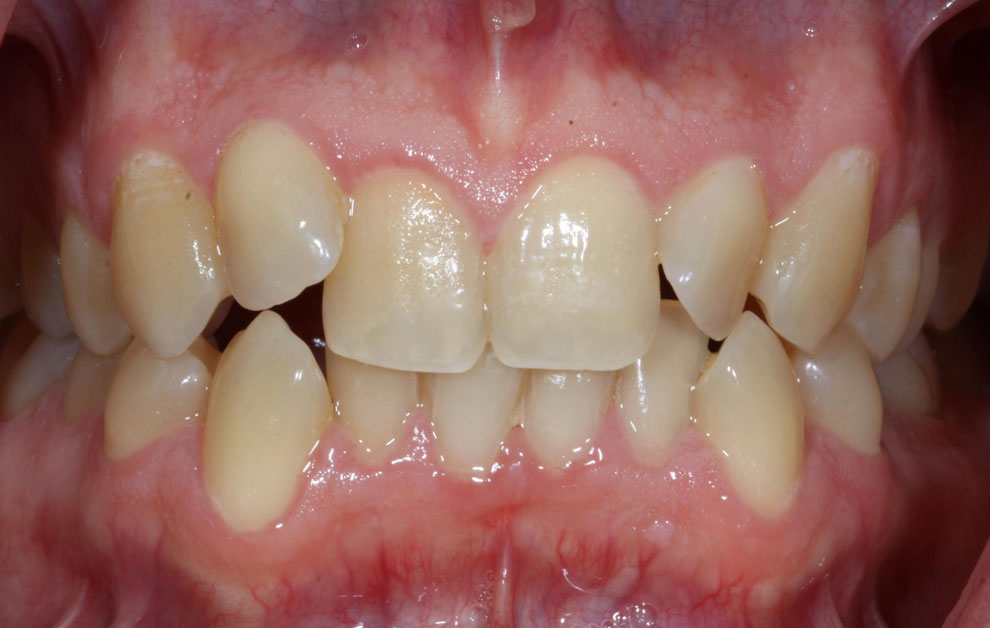 Before picture of teeth before procedure.