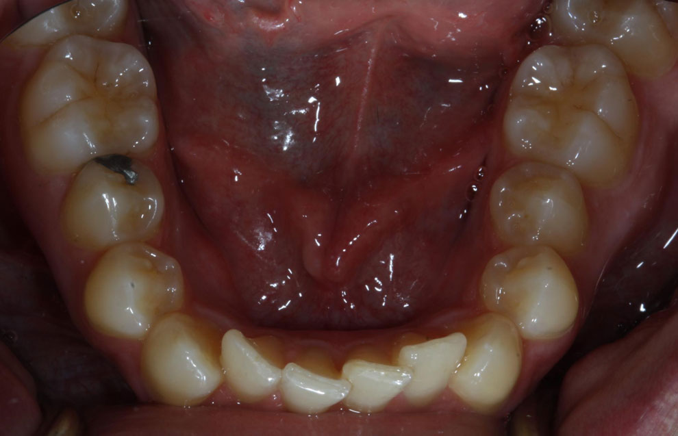 Before picture of teeth before procedure.