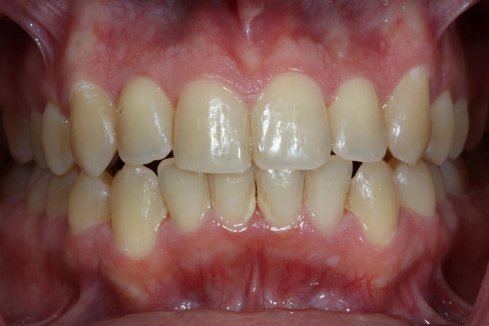 After picture of teeth when procedure is done.