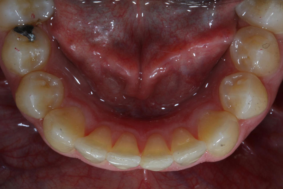 After picture of teeth when procedure is done.