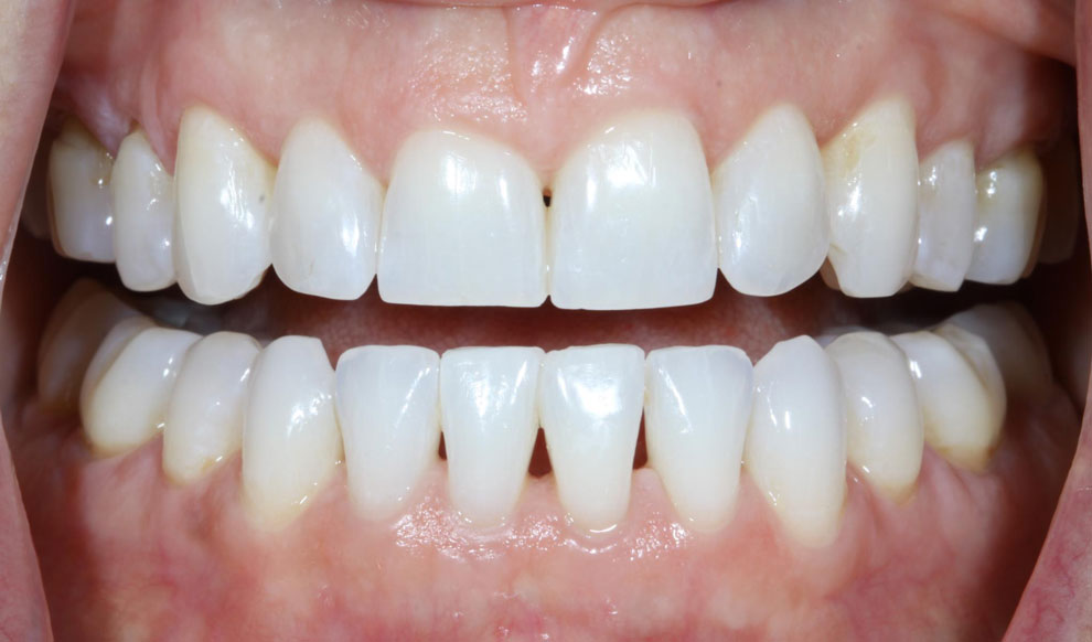 After picture of teeth when procedure is done.