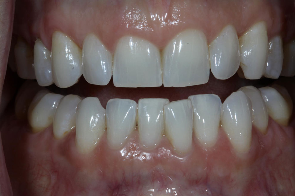 Before picture of teeth before procedure.