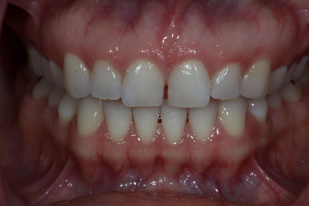 Before picture of teeth before procedure.