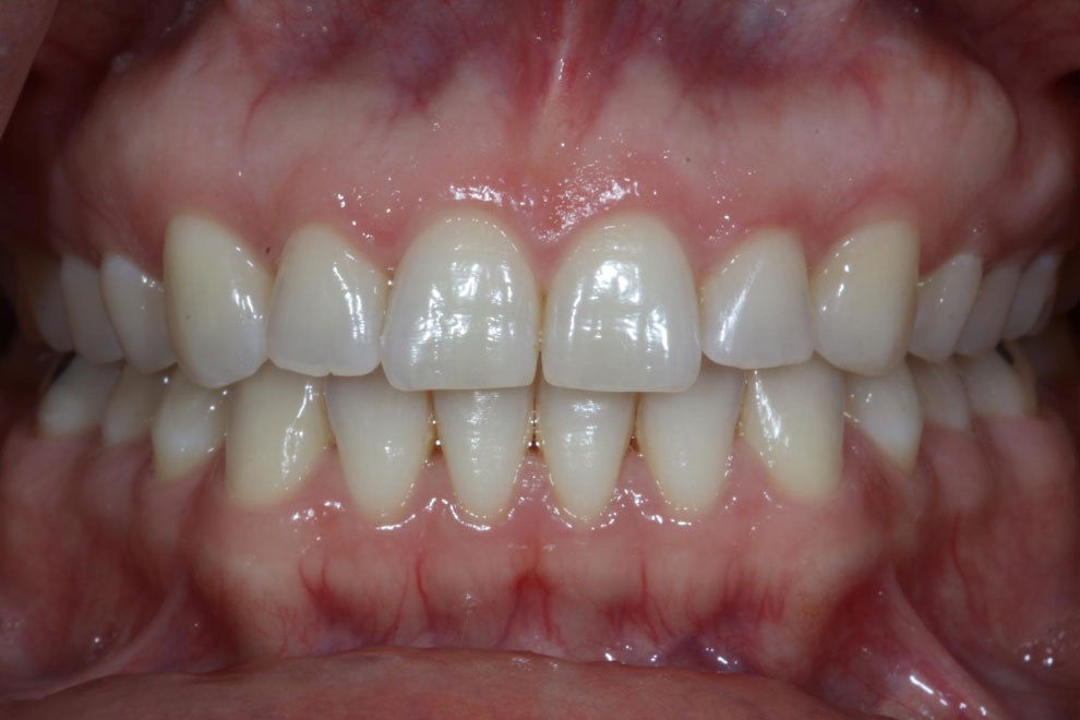 After picture of teeth when procedure is done.
