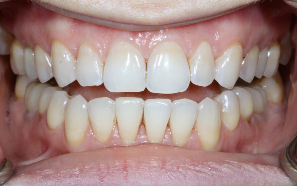 After picture of teeth when procedure is done.
