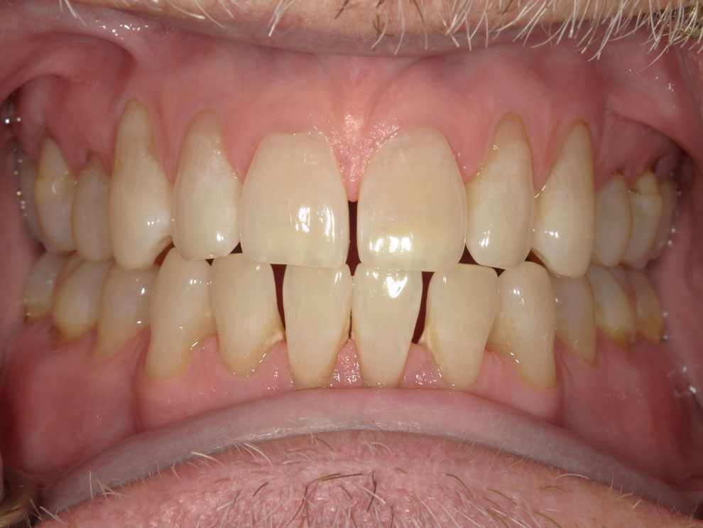 Before picture of teeth before procedure.