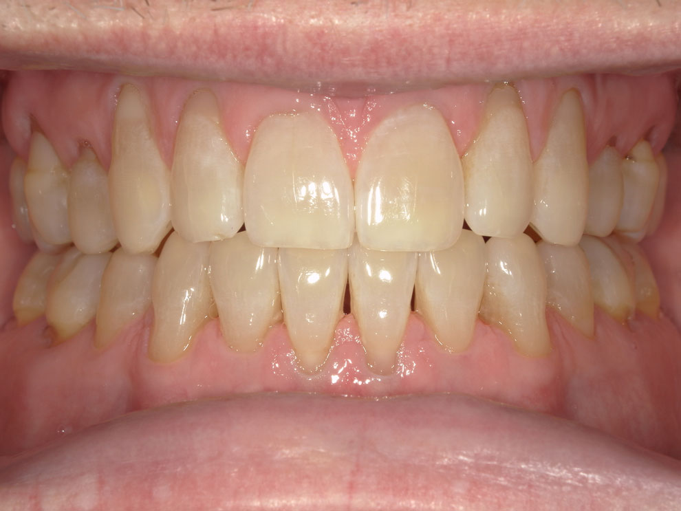 After picture of teeth when procedure is done.