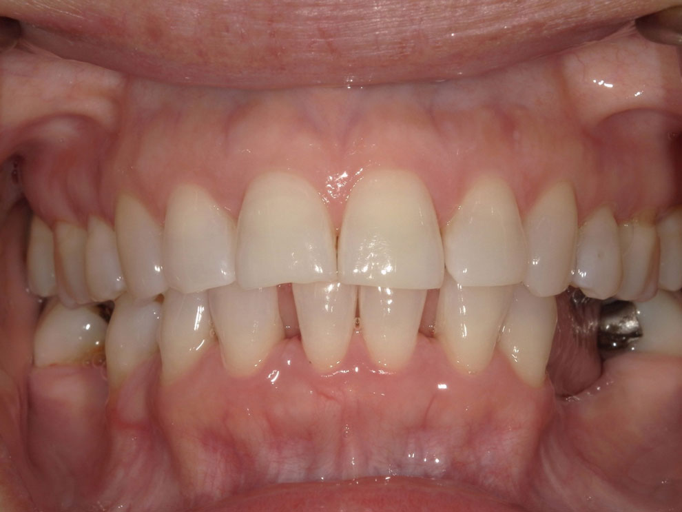 Before picture of teeth before procedure.