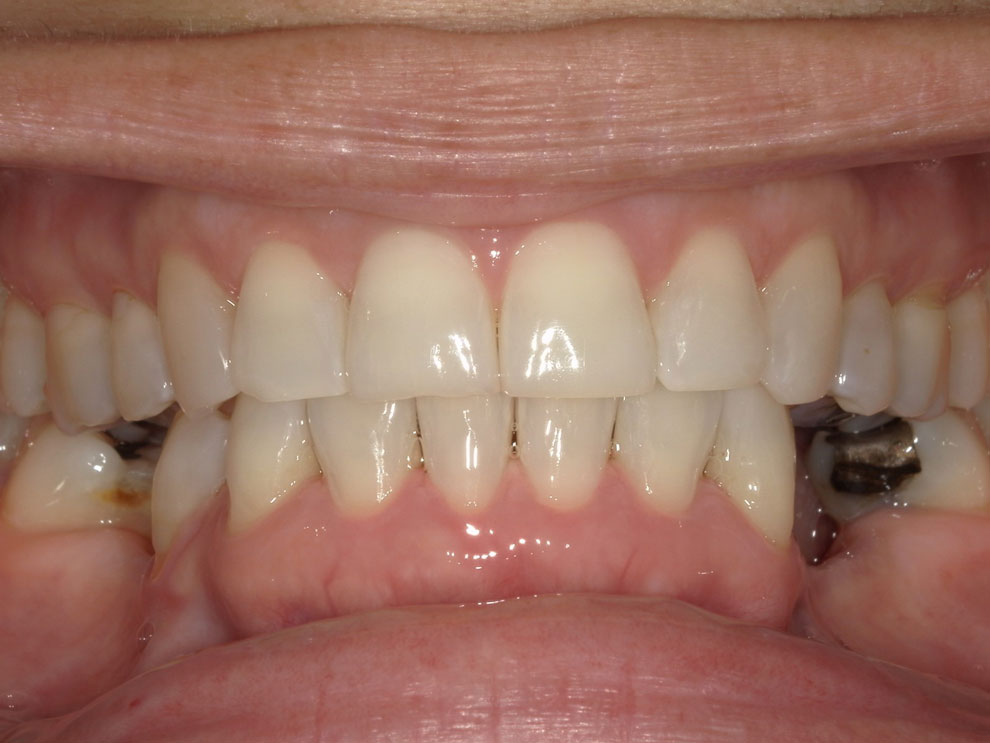 After picture of teeth when procedure is done.