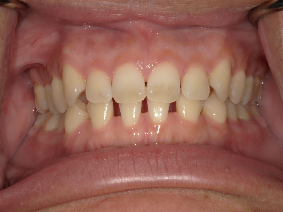 Before picture of teeth before procedure.
