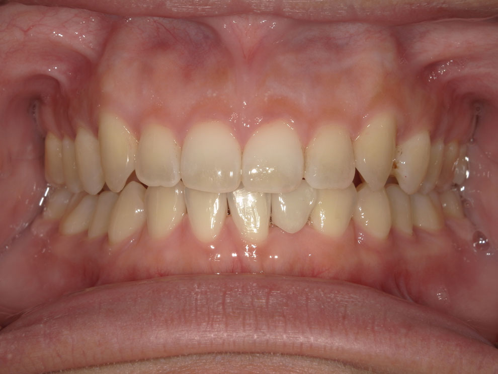 After picture of teeth when procedure is done.