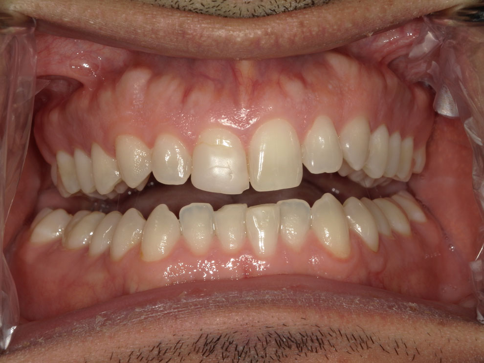 Before picture of teeth before procedure.