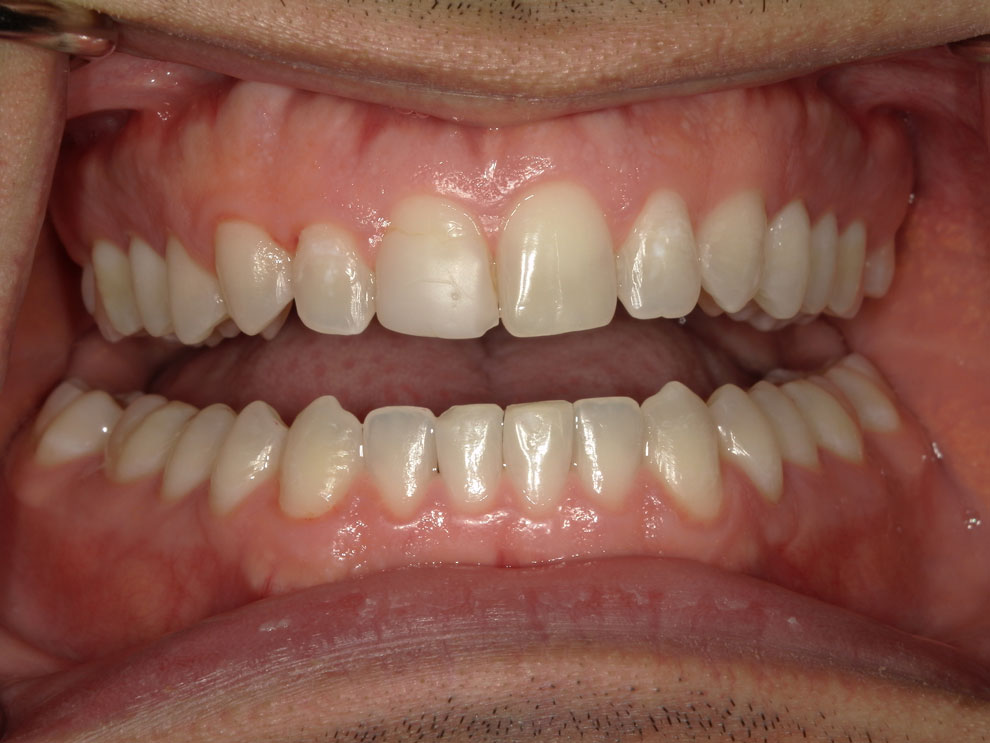 After picture of teeth when procedure is done.