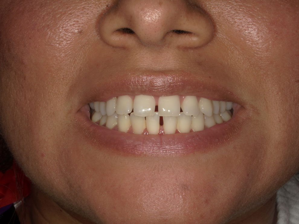 Before picture of teeth before procedure.