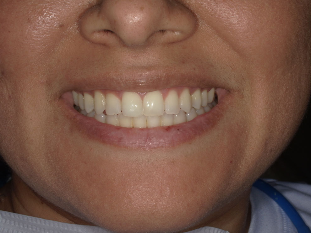 After picture of teeth when procedure is done.