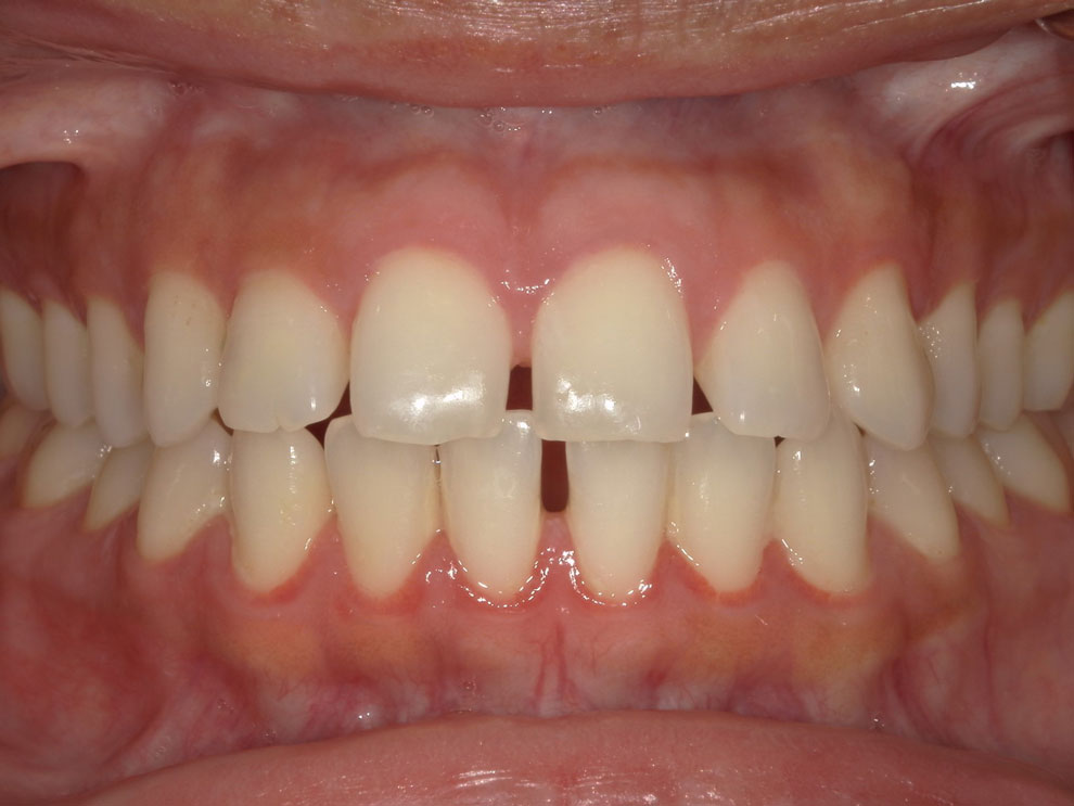 Before picture of teeth before procedure.