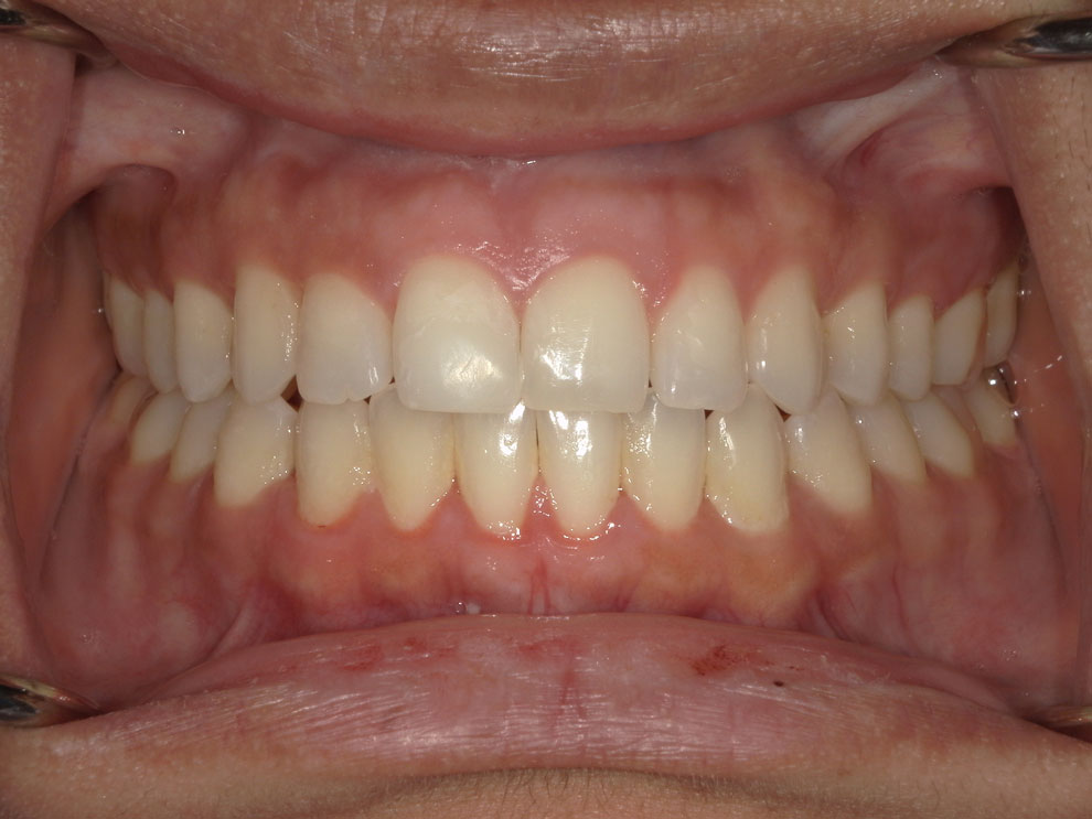 After picture of teeth when procedure is done.