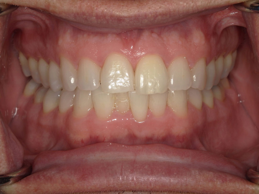 Before picture of teeth before procedure.