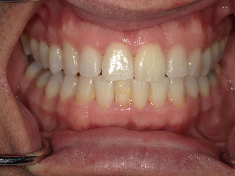 After picture of teeth when procedure is done.